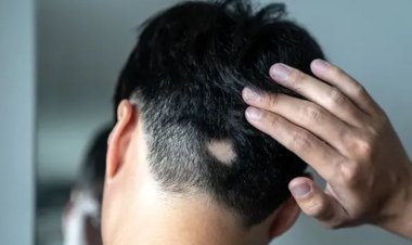 Alopecia Areata Homeopathy Treatment Offers Hope for Adults and Adolescents