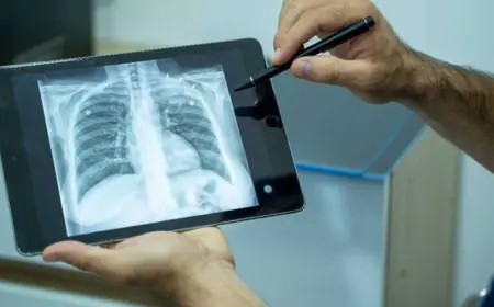 India has made Indigenous X-ray machine for testing TB with half of the price