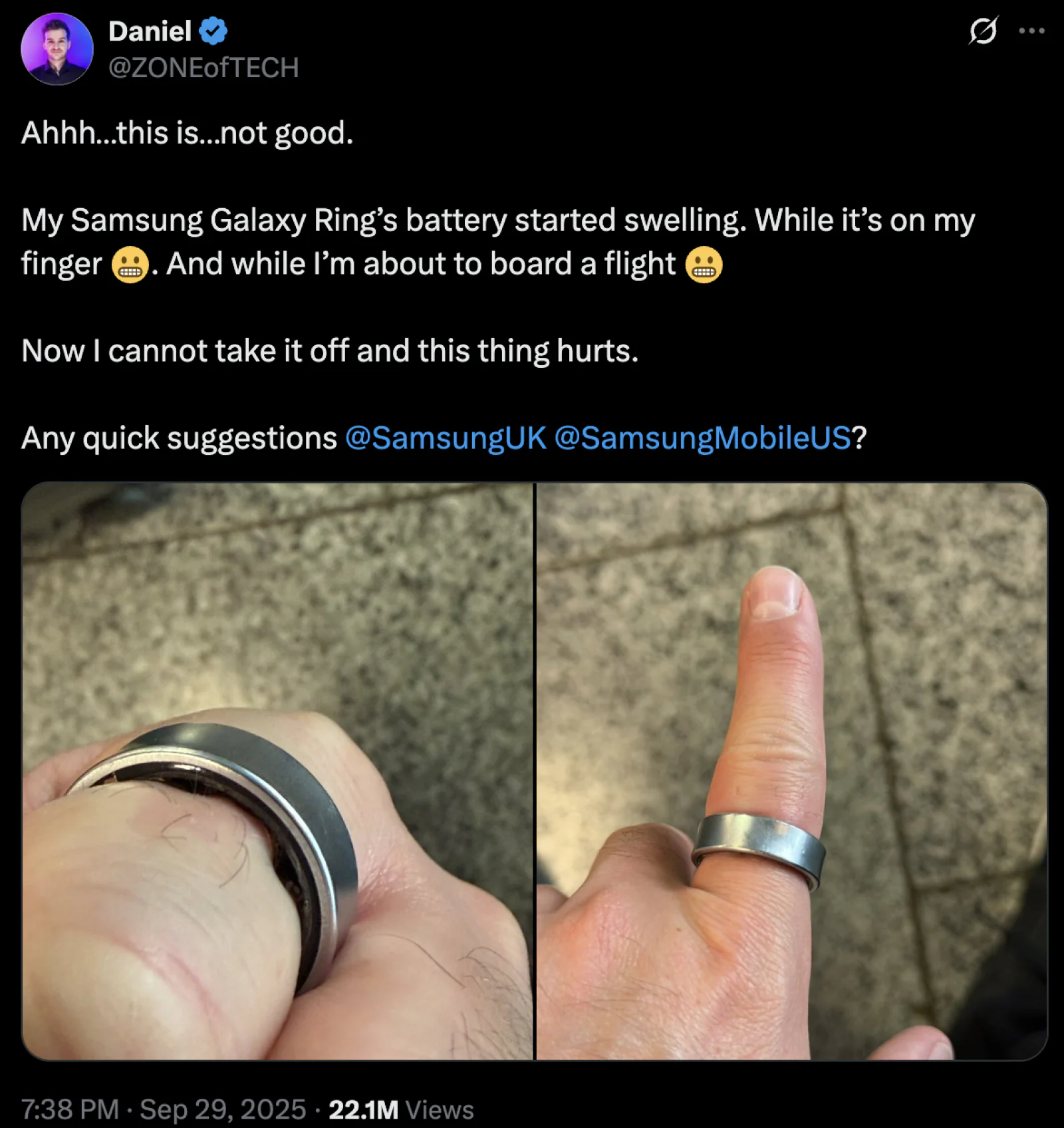 A smart ring landed a man in the hospital, and after his release, he said, "I'll never wear it again"