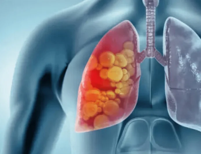 Lung Cancer Cases Rising Among Non-Smokers, Babubhai Jesangbhai Desai Tells Rajya Sabha